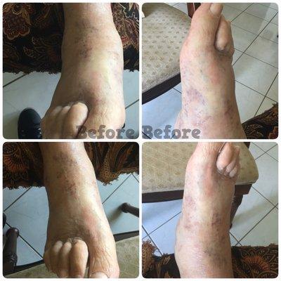 Manual Lymphatic Drainage Before and After for Edema