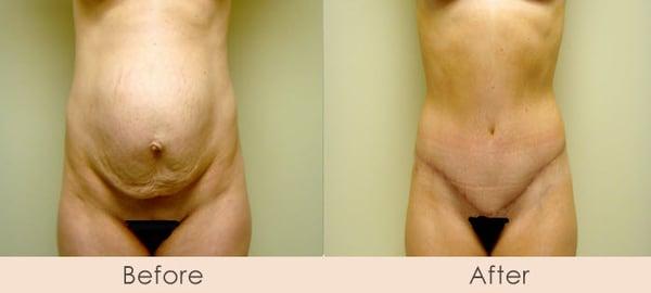 Tummy Tuck