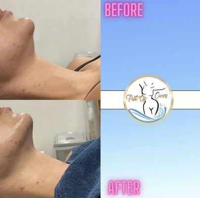 post op chin lipo