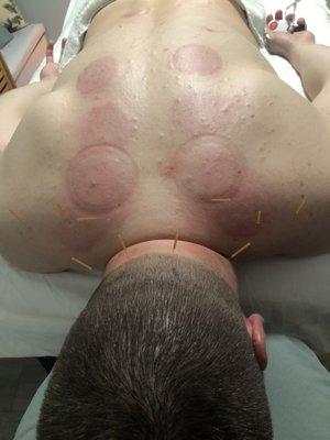 Needles after Fire  Cupping !