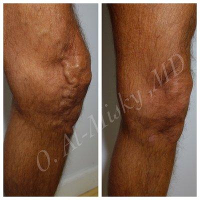 Before/After : Male Vein ablation for Varicose Veins.