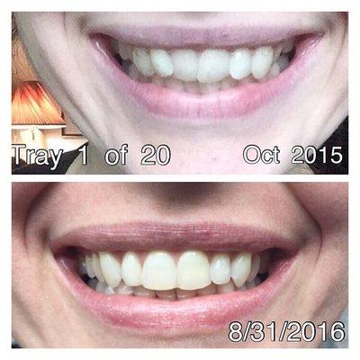 Before and after with Invisalign!