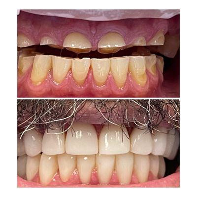 Bioclear Bonding upper and lower teeth. One day treatment-Life changing