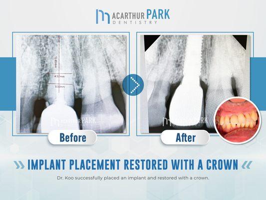 MacArthur Park Dentistry Emergency, Invisalign, Implant | Call: (972)831-9600