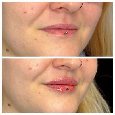 Lip Filler before and after