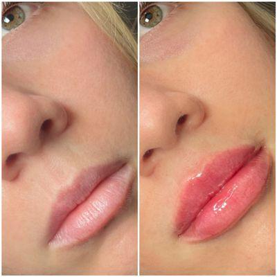 Lip Filler