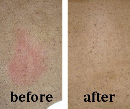 Red stain treatment.