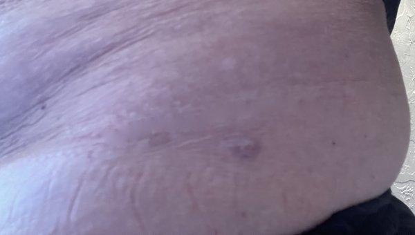 Scars on left hip above my bathing suit line I have these scars all over my body.