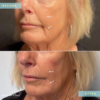 Nasolabial Folds & Marionette Lines Filler