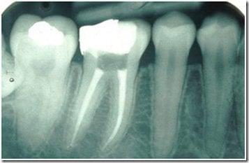 Easy and Safe Root Canal Treatments