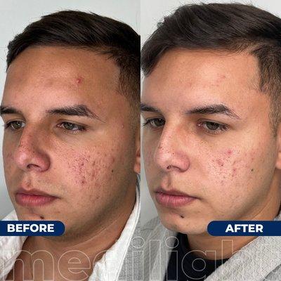 Before & After acne treatment