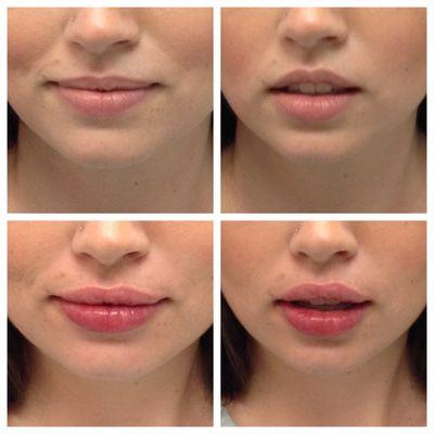 Lip Filler Before & After