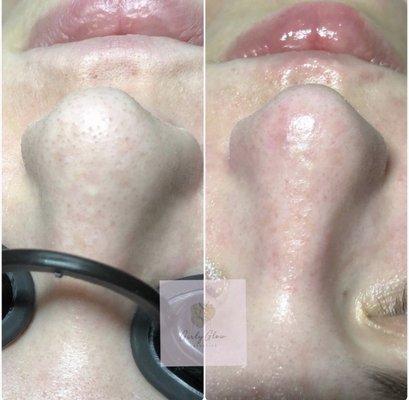 Before and after nose extractions