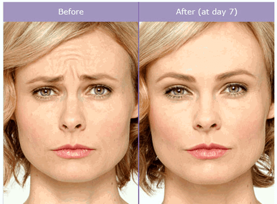 Botox before and after!