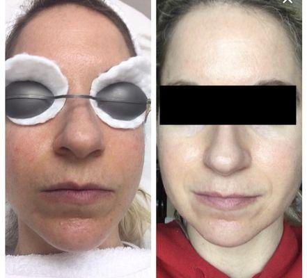 Skin rejuvenation using IPL after 3 treatments.