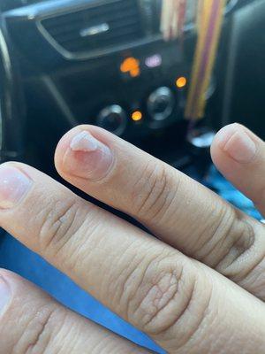 Acrylic left of nail because it was bleeding