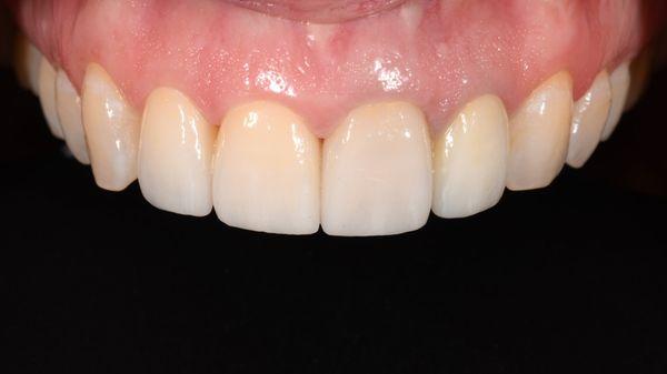 4 veneers