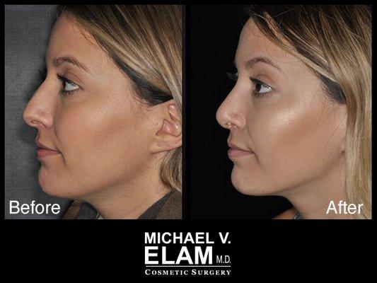 Rhinoplasty - 4 Weeks Post Op - 26 Year Old Woman