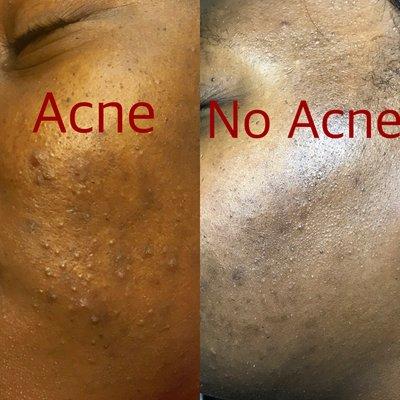 Results driven acne treatments