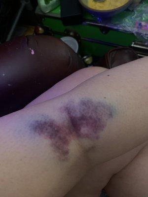 my bruise two days after.