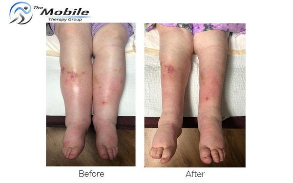 This is one of our patient's amazing results after only 6 weeks of lymphedema treatment!