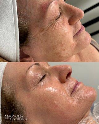 Our patient before & 12 weeks after customized skincare regimen.