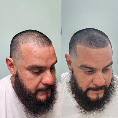 Scalp Micro-pigmentation