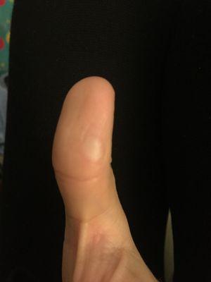 Burnt thumb