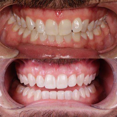 Invisalign & Teeth Whitening