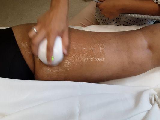 Cellulite reduction treatment on back of thighs