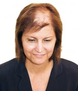 hair repalcement and hair restoration