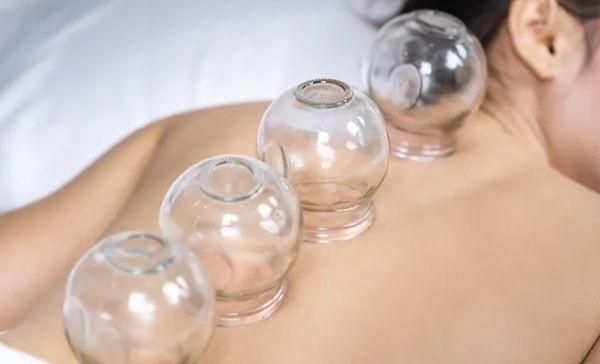 Cupping therapy