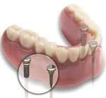 Dental Implant