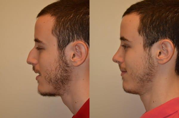 Two months after rhinoplasty surgery