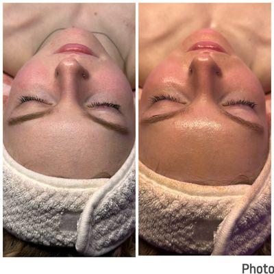 Before and after of hydrating dermaplane treatment