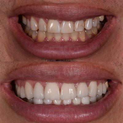 Natural Design Porcelain Veneers