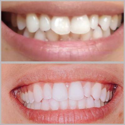 Before and After Six Month Smiles Clear Aligner Therapy