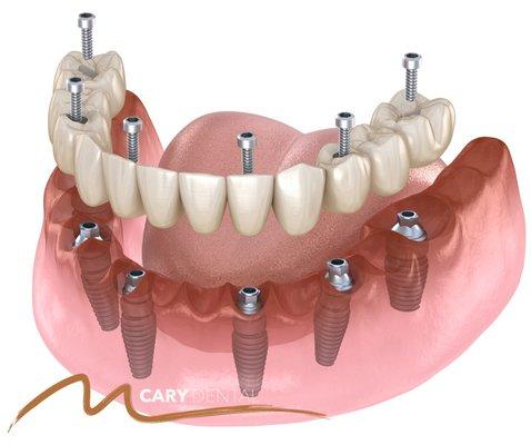 Dental Implants