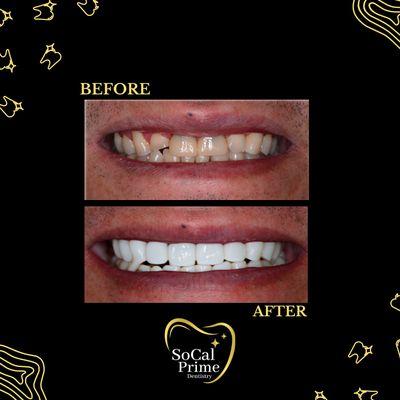 Revitalize your smile in a single visit! Experience the beauty of instant transformation with our anterior crowns.