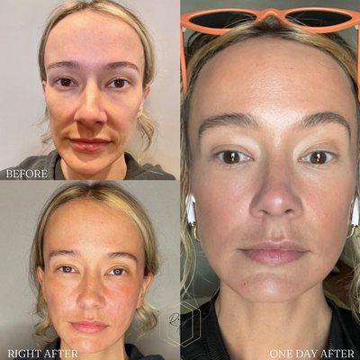 BEFORE & AFTER Sculptra for a more symmetric face as well as an even skin tone and a reduction in pore size.