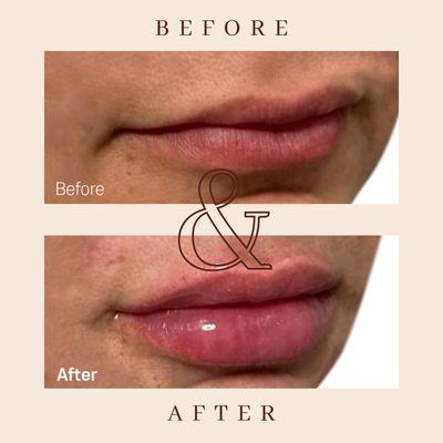 Lip filler