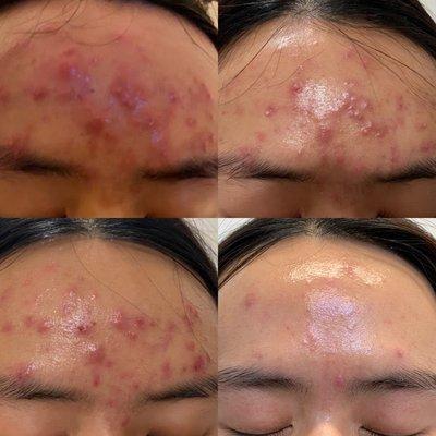 CLEARLY Acne Management Client