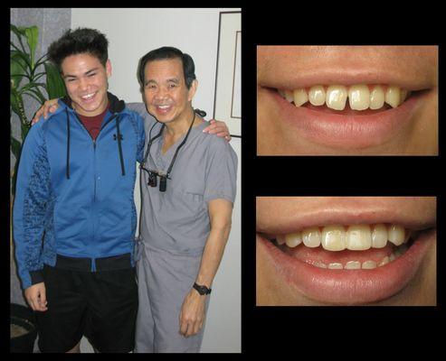 Before & after top teeth bonding and manicure!