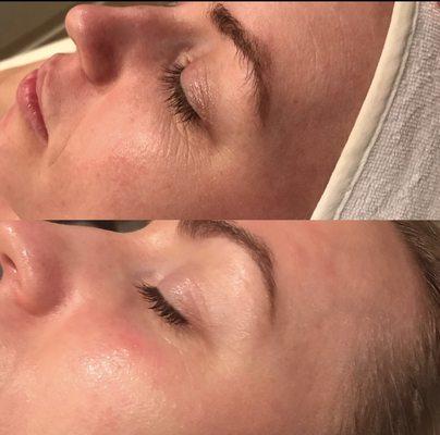 Before and after rezenerate anti aging facial