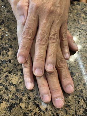 Hands before my treatment with Trish