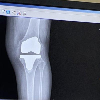 Knee replacement