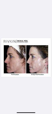 Before after Depigmentation System for Melasma