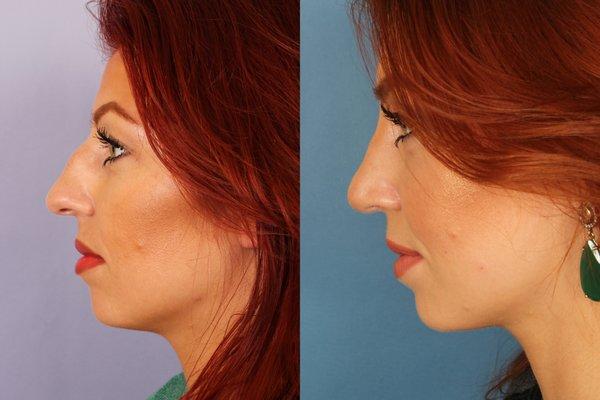 Rhinoplasty (Nose Job)