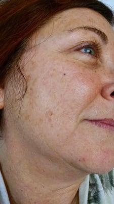 After - hyperpigmentation