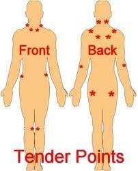 Also named trigger points, acupressure points